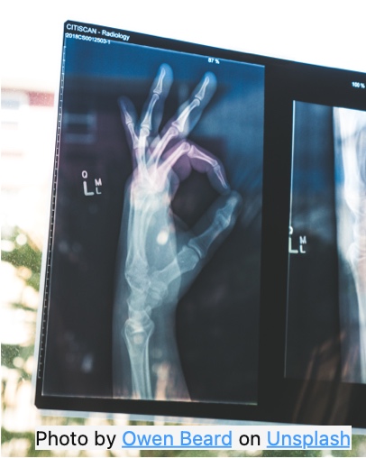 Healthy bones are easy to see in x-rays.