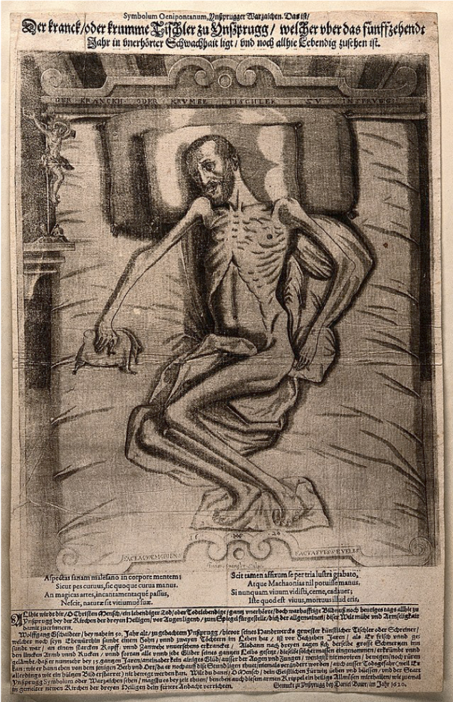 Sarcopenia is a general muscle wasting usually associated with aging and inactivity. 