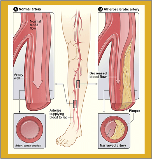 Peripheral Artery Disease Pad Planned Longevity