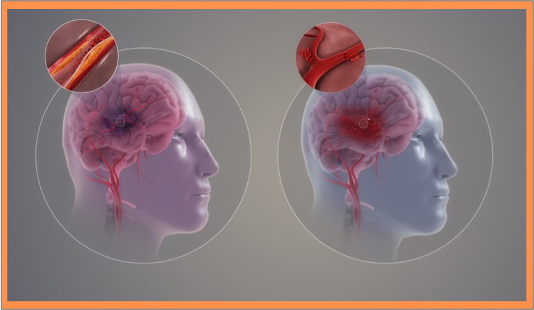 Strokes of two types Ischemic and Hemorrhagic. The pictures are side by side.