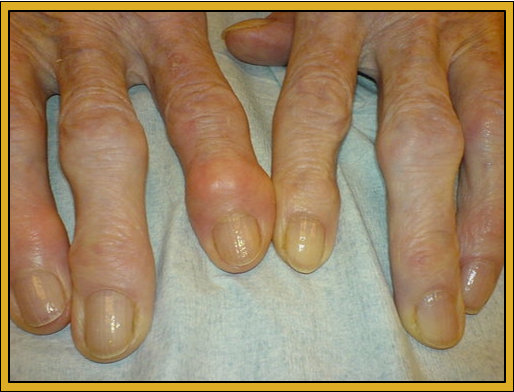 Osteoarthritis in hands with swollen joints.
